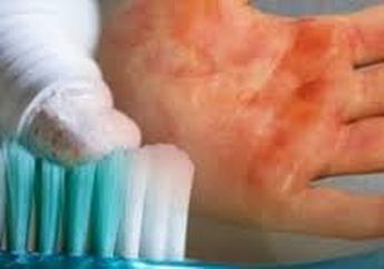 Sering Oles Pasta Gigi Pada Luka Bakar? Jangan Sampai Ini yang Akan Terjadi Padamu