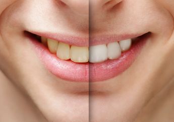 Nggak Perlu Mahal Bleaching Gigi, Cara Ini Bikin Gigi Putih Secara Instan loh