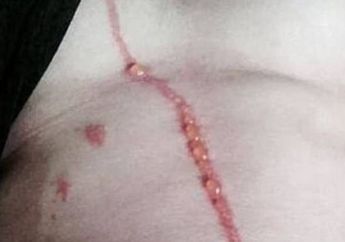 Dikira Luka Biasa, Namun Ada yang Bergerak Didalam Tubuhnya! Saat Dibuka Ternayata Ada Ini