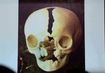 Terlahir dengan Wajah Langka Anak Ini Disebut Mask Boy, Kondisinya Bikin Prihatin!