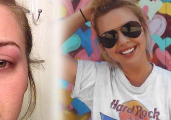 Duh Miris! Jangan Pencet Jerawat, Kalau Nggak Mau Kejadian Nahas Ini Menimpa Kalian