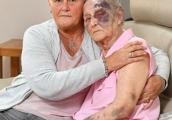 Tega! Kisah Memilukan Dibalik Rusaknya Wajah Nenek Mantan Kapten Tim Rugby