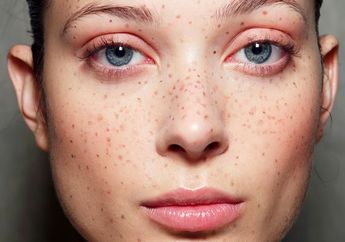 Di Wajahmu Ada Bercak Hitam? Wah Jangan-jangan Kamu Alami Ini