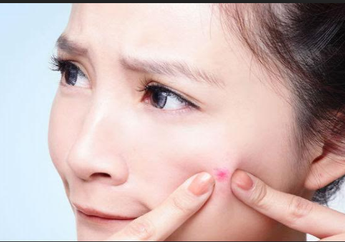 Kata Dokter Kulit Soal Dampak Memencet Jerawat Sendiri di Rumah: Peradangan, Ngeri euy! 