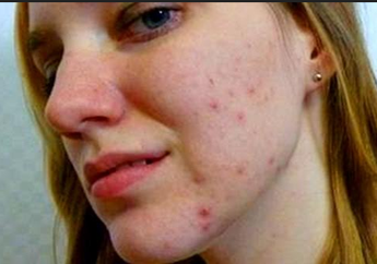 Mudah dan Murah, Inilah 6 Bahan Alami Hilangkan Bekas Jerawat dari Wajah