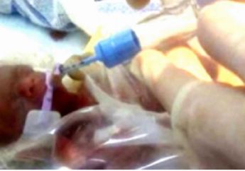 Kasihan! Bayi Ini Saat Lahir Hanya Berukuran Sebesar Bola Tenis