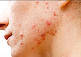 Tingkatan Fase Jerawat: dari Komedo Lalu Infeksi dan Peradangan Hingga Bernanah, Ngeriii!!!