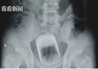 Hah, Ada Gelas Kaca di Dalam Pantat Seorang Pria! Gimana Masuknya?