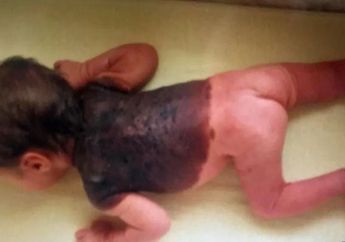 Setiap Hari, 'Tanda Lahir' Bayi Perempuan ini Terus Membesar, Beginilah Kondisinya Ketika Dia Telah Dewasa