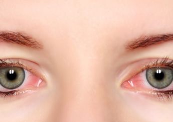 3 Masalah Mata Merah yang Perlu Diwaspadai, Nomor 3 kok Berpasir?