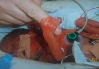 Divonis Mati oleh Dokter, Bayi Prematur Ini Memegang Jari Ibunya, Ini yang Terjadi Setelahnya!