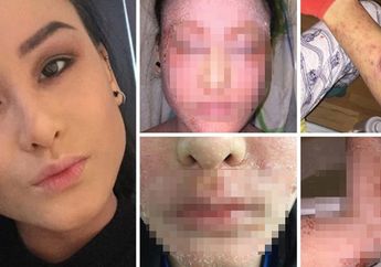 Waspada, Kulit Hancur Akibat Keterusan Pakai Obat, Penyakit Ini Pernah Dialami Jutaan Orang Dewasa dan Anak-Anak, Begini Caranya Agar Lekas Sembuh