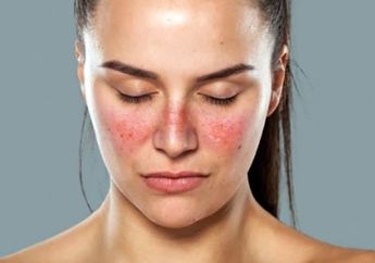 Awas! Inilah 4 Jenis Penyakit Autoimun yang Menyerang Banyak Wanita