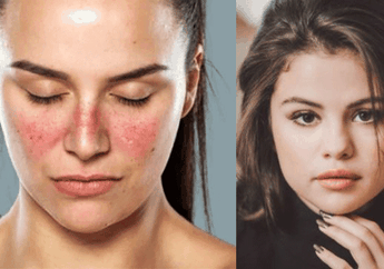 Dikenal Sebagai Penyakit Seribu Wajah, Ini Dia 9 Fakta Penyakit Lupus yang Menyerang Selena Gomez, Kebanyakan Penderitanya Wanita!
