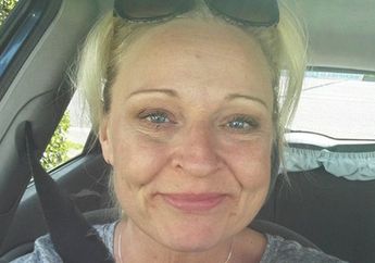 Wajah Ibu Ini Dimakan Bakteri Langka, Dokter Terpaksa Mengiris Wajahnya Untuk Menyelamatkan Hidupnya, Lihat Foto Perjuangannya!