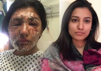 Masih Ingat Model Cantik yang Disiram Air Keras Saat Ulang Tahunnya? Inilah Foto Transformasi Penyembuhan Mukanya