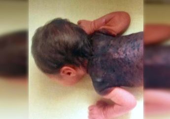 Terlahir Dengan Tanda Kulit Hitam dan Mengerikan, Setelah 28 Tahun Sungguh Mengejutkan Kondisi Wanita Ini