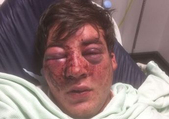 Berjalan Jam 3 Pagi Sendiri, Pria Ini Malah Bernasib Malang, Wajahnya Hancur Berantakan, Kenapa Ya?