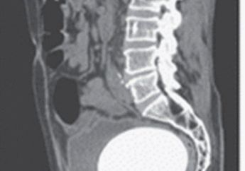 Busett! Batu Sebesar Telur Burung Unta 'Nyangkut' Di Saluran Kandung Kemih Seorang Pria