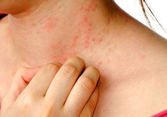 Eksim Dilarang Digaruk, Begini Cara Atasinya