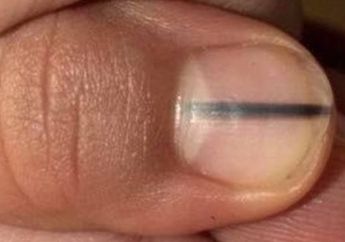 Punya Garis HItam di Kuku? Bisa Jadi Ini yang Kamu Alami
