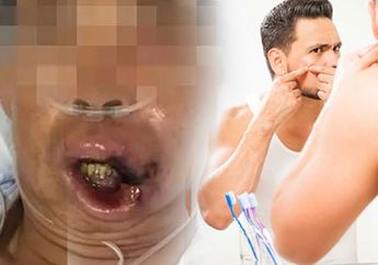 Jangan Sembarangan Memencet Jerawat Pada Bagian Ini, Pria Ini Hampir Meninggal Karenanya