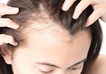 Kepala Botak Ternyata Bisa Jadi Pertanda Penyakit Ini, Bahaya Nggak ya?