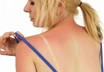 Nggak Pede dengan Kulit Belangmu? 4 Cara Ini Dijamin Ampuh Untuk Menghilangkan Belang Pada Kulit