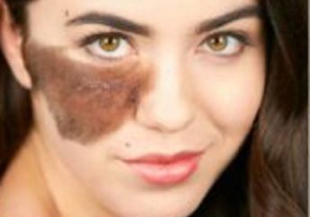 Lihatlah 7 Foto Orang Dengan Tanda Lahir Unik Ini, Mengagumkan!