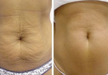 Kulit Kendur Setelah Hamil? Ini 5 Cara Terbaik Untuk Membuatnya Kencang Kembali