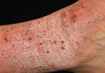 Inilah Kesalahan yang Sering Dilakukan oleh Penderita Eksim, Bikin Makin Parah loh