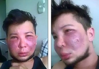 Niatnya Biar Tambah Ganteng, Namun Buruk Rupa Yang di Dapat Pria Ini