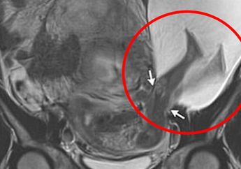 Bahagia Akhirnya Hamil, Tapi Kaki Bayi Malah Sudah Keluar dari Rahim Duluan, Ngeri, Jangan Sampe Ini Terjadi Lagi