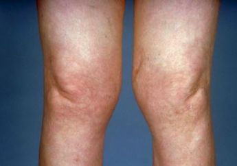 Sudah Tahu Tentang Penyakit Lyme? Rupanya Dialami Juga Oleh Selebriti Dunia loh, Memangnya Apa sih Itu? 