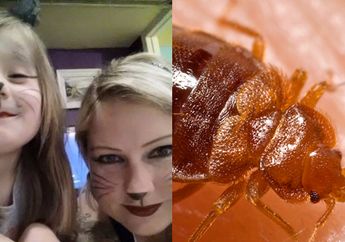 Tidur di Pesawat Ibu dan Anak Ini Diserang Kutu Busuk, Hingge Seperti Ini Luka yang Dialaminya