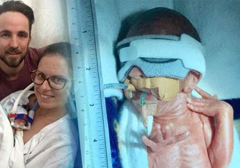 Keajaiban, Bayi Terlahir Seukuran Botol Beginilah Kisah Mengharukannya Selamat dari Maut dan Berjuang Untuk Hidup