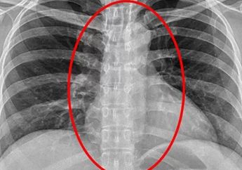 Astaga! Ada Kondom di Saluran Pernafasan Wanita Ini, Ternyata Gini Penyebabnya, Sampai Dokter Geleng-geleng Kepala