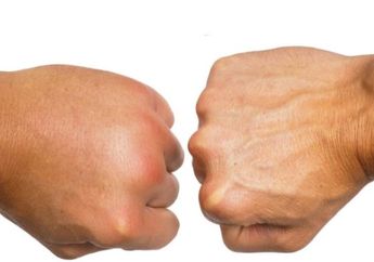 Edema Bisa Bikin Bagian Tubuh Ini Bengkak, Apaan sih Itu?