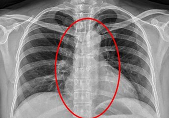 Telan Kondom Lalu Kehabisan Nafas dan Dehidrasi, Akhirnya Wanita Ini Dipenjara 2 Bulan