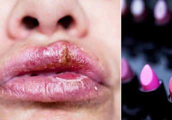 Kena Herpes di Bibir, Wanita ini Mengaku Gara-gara Lakukan Kebiasaan Sepele Saat di Mal