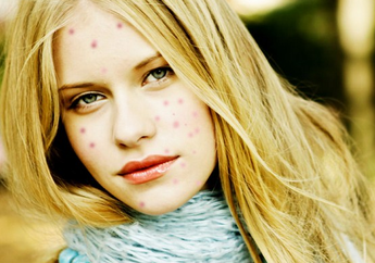 Punya Bekas Cacar Air yang Mengganggu Penampilan? Hilangkan dengan 9 Bahan Alami Ini!