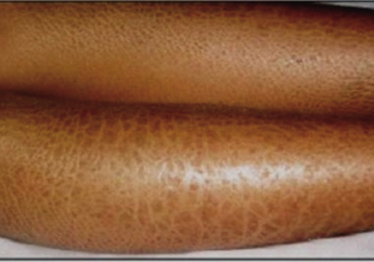 Kulit Bersisik dan Tebal? Kamu Pasti Alami Ini, Lihat Gejala Lainnya di Sini