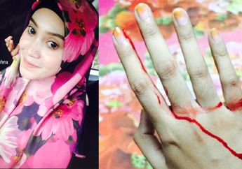 Jari Perempuan Ini Berdarah Darah Digigit Tikus Saat Dirinya Tidur