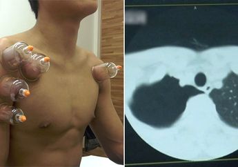 Coba Bekam untuk Sembuhkan Bronkitis, Paru-paru Pria Ini Malah Menyusut 90 Persen, Ternyata Ini Penyebabnya