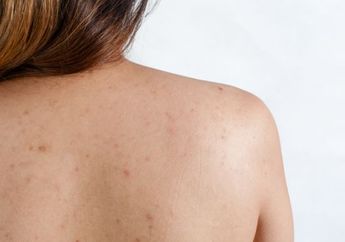 Muncul Jerawat di Punggung dan Bokong, Begini loh Cara Mudah Mengobatinya