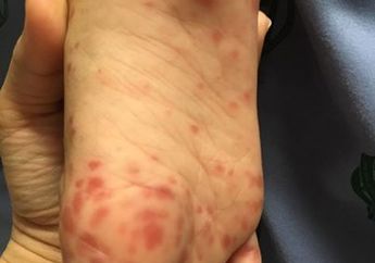 Kaki Bayinya Tiba-tiba Berbintik dan Melepuh, Ibu Ini Peringatkan Netizen Akan Penyakit Ini