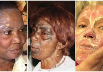 Niatnya Pengen Putih, Kulit 3 Wanita Ini Jadi Seperti Terbakar Karena Krim Pemutih Wajah 