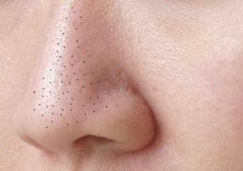 Cukup Pakai 3 Bahan, yuk Hilangkan Komedo Membandel di Wajah