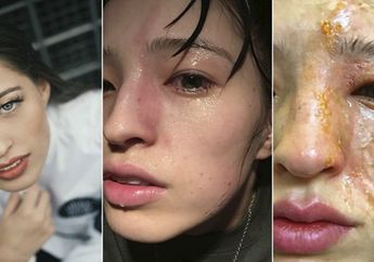 Wajah Perempuan Cantik Ini Rusak Parah Setelah Salah Pake Minyak Ini