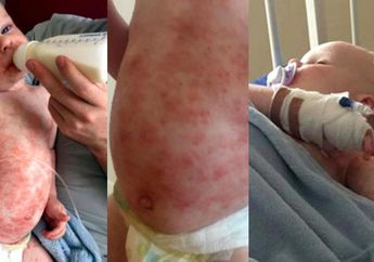 Ibu Bawa Anaknya ke Dokter, Hanya Diberi Salep dan Disuruh Pulang, Ternyata Tertular Virus Berbahaya ini